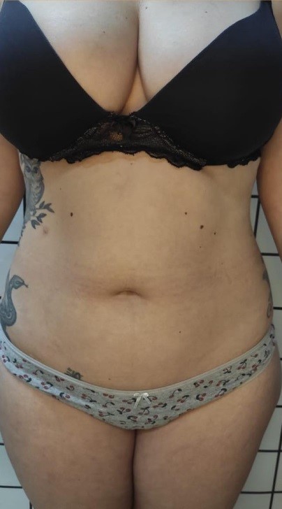 Imagem antes: Abdominal