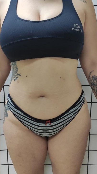 Imagem depois: Abdominal