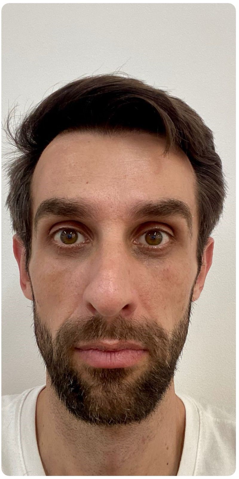Imagem antes: Botox