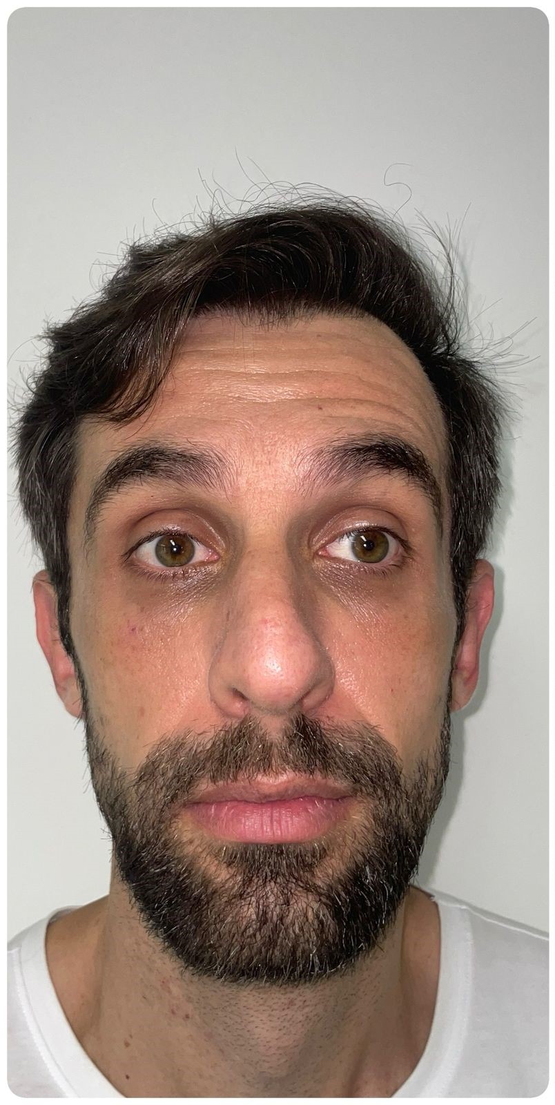 Imagem depois: Botox